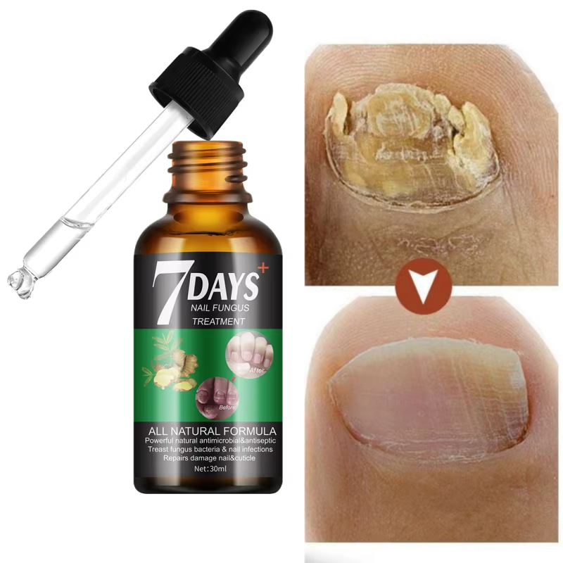 MOOYAM 30ml Serum: 7-Day Nail Fungus Treatment Solution